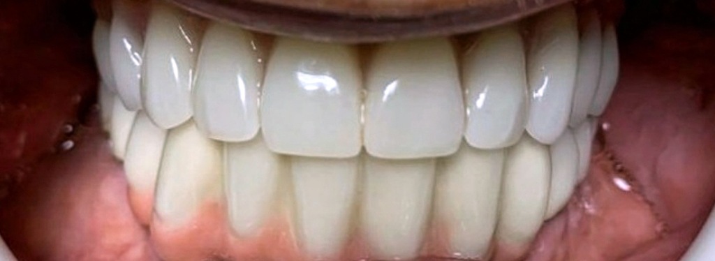 Dantura fixa In 12 ore - Clinica HMDent - Dental Implant